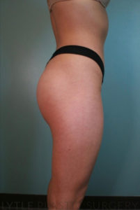 Butt Augmentation Results Detroit