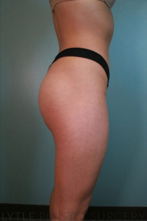 Butt Augmentation