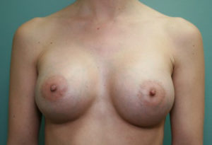 Breast Augmentation