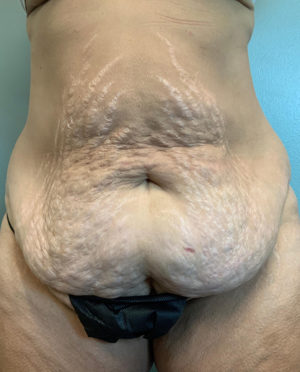 Abdominoplasty