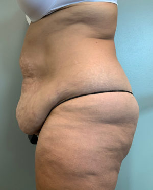 Abdominoplasty