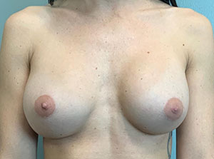 Breast Augmentation