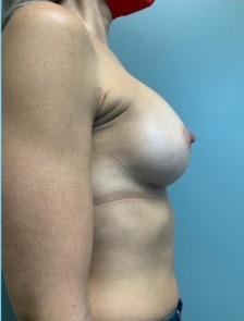 Breast Augmentation