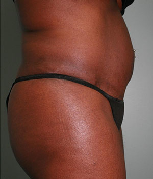 Abdominoplasty