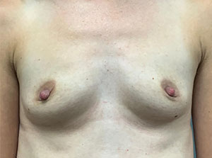 Breast Augmentation