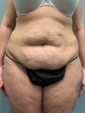 Abdominoplasty