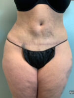 Abdominoplasty