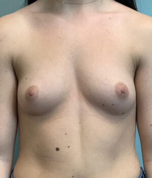 Breast Augmentation