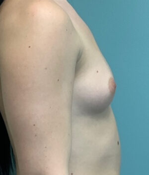 Breast Augmentation