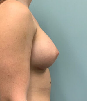 Breast Augmentation