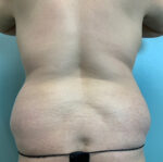 Liposuction