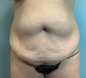 Abdominoplasty