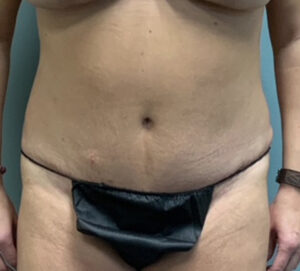 Abdominoplasty