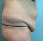 Abdominoplasty