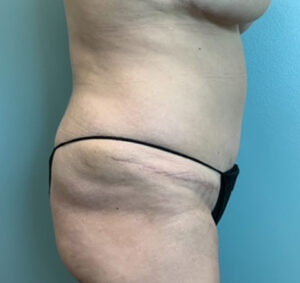 Abdominoplasty