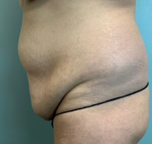 Abdominoplasty