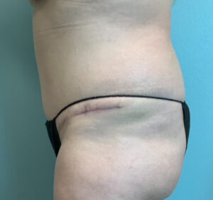 Abdominoplasty