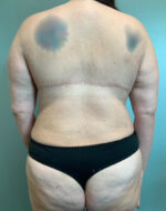 Back Lift Before & After Pictures