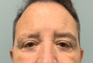 Blepharoplasty