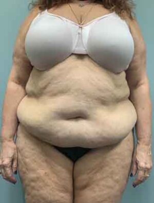 Liposuction