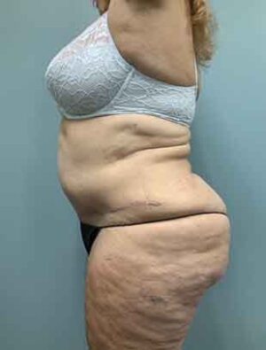 Liposuction