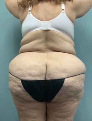 Liposuction