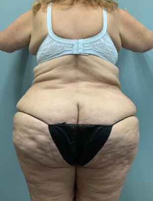 Liposuction