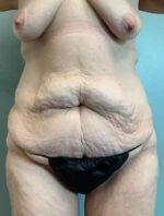 Abdominoplasty Before & After Pictures