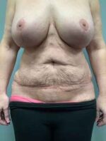 Abdominoplasty Before & After Pictures