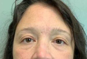 Blepharoplasty