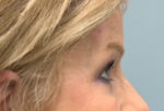 Blepharoplasty Before & After Pictures