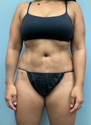 Abdominoplasty Before & After Pictures