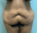 Abdominoplasty