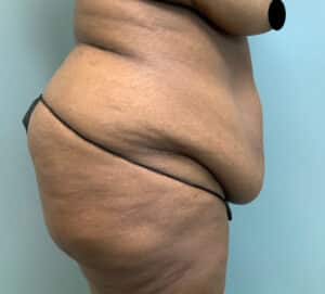 Abdominoplasty Before & After Pictures