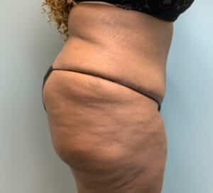Abdominoplasty Before & After Pictures