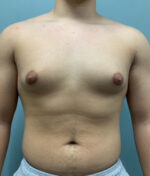 Gynecomastia