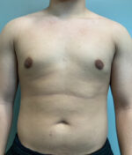 Gynecomastia