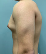 Gynecomastia