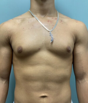 Gynecomastia