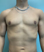 Gynecomastia