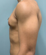 Gynecomastia