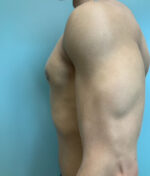 Gynecomastia