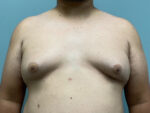 Gynecomastia