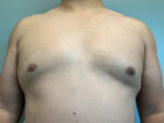 Gynecomastia