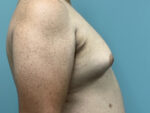 Gynecomastia