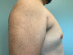 Gynecomastia