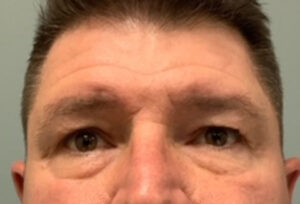 Blepharoplasty Before & After Pictures