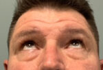 Blepharoplasty Before & After Pictures