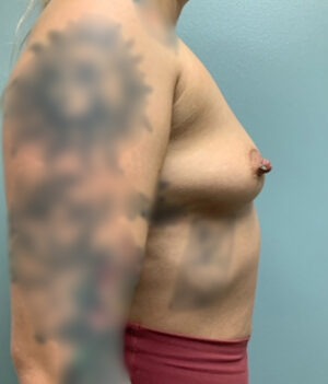 Breast Augmentation