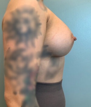 Breast Augmentation